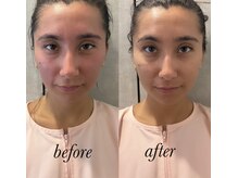 マホロバ(mahoroba)/よもぎ蒸し＋美容鍼