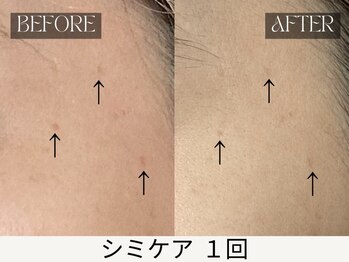 スキンジム(SKIN GYM)/シミケア いまだけ3500円