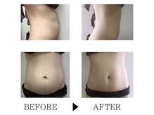 ソルニス(Solnis.)/痩身☆脂肪分解/ハイパーナイフ