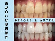 ホワイトニングショップ 八王子店/ホワイトニングビフォーアフター