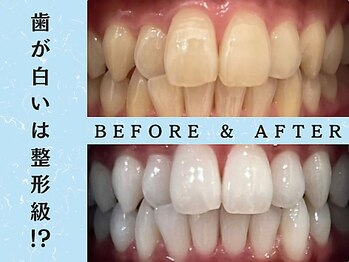 ホワイトニングショップ 八王子店/ホワイトニングビフォーアフター