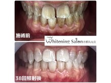 ホワイトニングサロン 京都烏丸店/ホワイトニング施術例