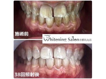 ホワイトニングサロン 京都烏丸店/ホワイトニング施術例