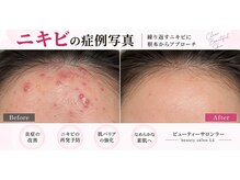 ラー(La)の雰囲気（ニキビ集中ケアで繰り返すニキビを根本からアプローチ）