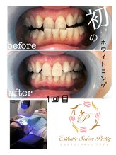 エステティックサロン プリティ/セルフホワイトニング