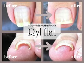 アクリルでの巻き爪ケア