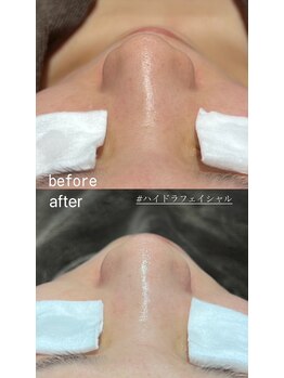 ファウンデーション(FOUNDATION)/ハイドラフェイシャル