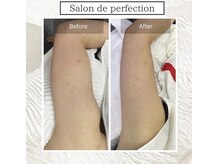 サロン ド パーフェクション(Salon de Perfection)/本気の痩身