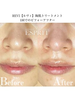 エスプリ 銀座店/ハーブピーリング銀座