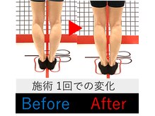 池袋東鍼灸整骨院/O脚矯正