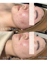 プレジール(plasir)/ニキビケアお任せ下さい！