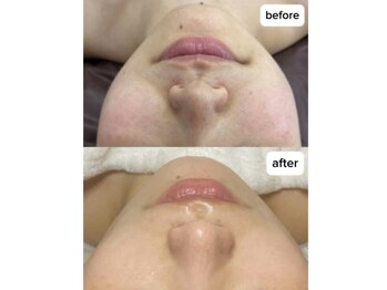 チェルト 鈴鹿店(CERTO)/REVIハーブピーリング