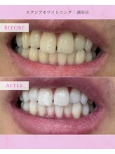 エクシアホワイトニング 調布店/20代男性会員様/営業職で印象UP