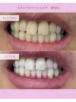 エクシアホワイトニング 調布店/20代男性会員様/営業職で印象UP