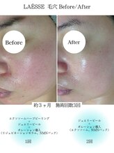 ルノン(LUNON)/毛穴Before/After