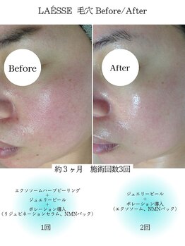 ルノン(LUNON)/毛穴Before/After