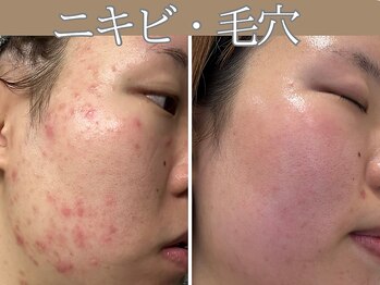 ハウオリ(HAUOLI)/毛穴悩み／ニキビ悩み