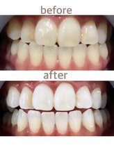 セルフホワイトニング専門店　 ホワイトニングショップ船橋2号店【ホワイトニング】/Before&After美白ホワイトニング