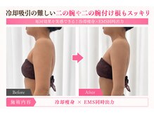 オリエンタルローザ 表参道(Oriental Rosa)/冷却痩身×EMSで二の腕華奢見え