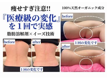 イーズ ららぽーと湘南平塚店(E/S)の写真/エステの限界を超えた☆レモンボトル6CC打ち放題×強力リンパデトックスでたっぷり施術!速攻痩せを実現!