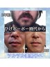 大人気☆しっかり効果発揮☆【ヒゲ脱毛】【部分脱毛】¥6000→初回¥4800