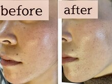 エスデザイン(es design)/フェイシャル／美白／くま／毛穴