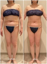 クラヴェル(Clavel)/50代後半セルゼロ2症例