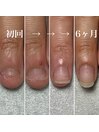 爪噛みさんの深爪矯正記録