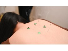 スキャプラ あざみ野荏田店(SCAPULA)の雰囲気(鍼灸施術も行っています!美容鍼も大人気◎)