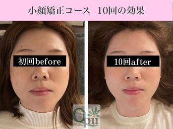 キュープ 表参道店(Qpu)/小顔矯正10回コースの変化