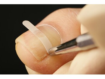 上高田つつじ整体院/ドイツ式巻き爪補正