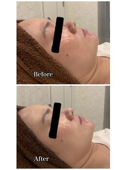 ブランシュール/エンビロンブライトセラム導入