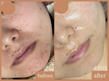 リムーン 岡崎(Re'moon)/REVI ハーブピーリング