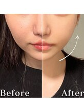 ミニョスキンラボ/小顔EMSリフト6回