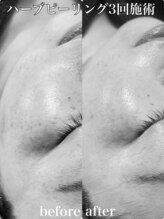 ビエン(bien)/施術3回.陶肌ハーブピーリング