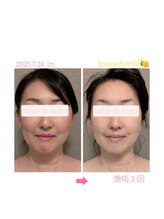 サロン ド 花歩 松山本店/お顔１回施術で浮腫みも解消！