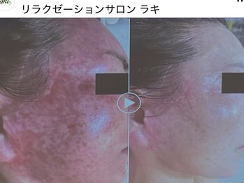 リラクゼーションサロン ラキ(laki)/スキンメイド/トロイアルケ