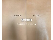 ルナソルビューティーサロン 浜松店(Lunasol)/背中 MIX脱毛♪