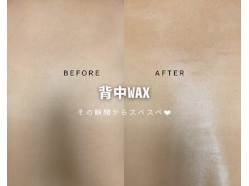 ルナソルビューティーサロン 浜松店(Lunasol)/背中 MIX脱毛♪