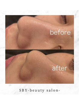 エスビーワイビューティー(SBY Beauty)/新宿ハイドロ/新宿ハイドラ