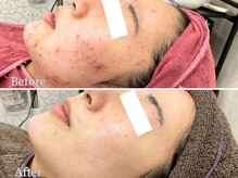ニキビケア研究所 本厚木店/どんなニキビでもお任せください