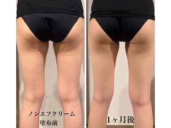 エステサロンブランシュ(Esthe salon Blanche)/ポコポコセルケア、引き締めケア