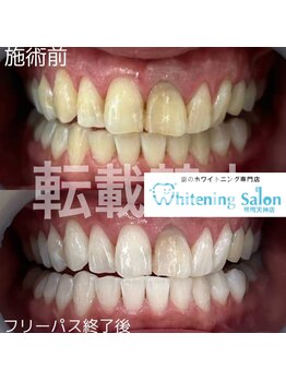 ホワイトニングサロン 福岡天神店/ホワイトニング