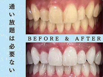 ホワイトニングショップ 八王子店/ホワイトニングビフォーアフター