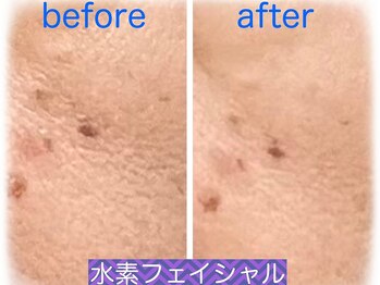 サロン ド ミコ(Salon de Mico)/水素導入フェイシャル