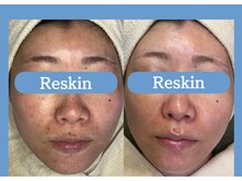 リスキン(Reskin)の雰囲気（【WIQO水光ピール】繰り返す肌トラブル、根本的な肌質改善に◎）