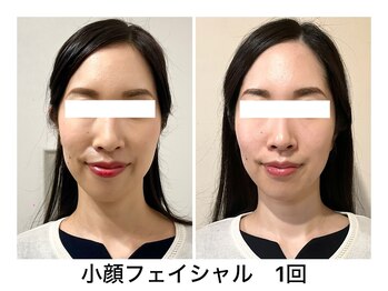 ナルシス/【小顔ケア】1回の変化★