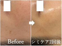 ニコ アンド キャンディー(Nico.&Candy)/本気でシミ改善したい方募集中