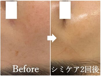 ニコ アンド キャンディー(Nico.&Candy)/本気でシミ改善したい方募集中