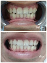 エクシアホワイトニング 稲沢店/お客様ビフォーアフター